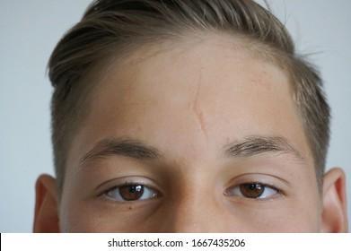 forehead scar